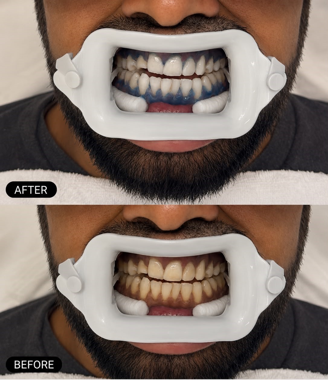 Teeth Whitening In-Clinic Treatment 1