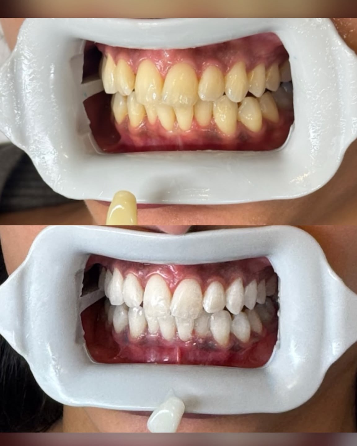 Teeth Whitening In-Clinic Treatment 2