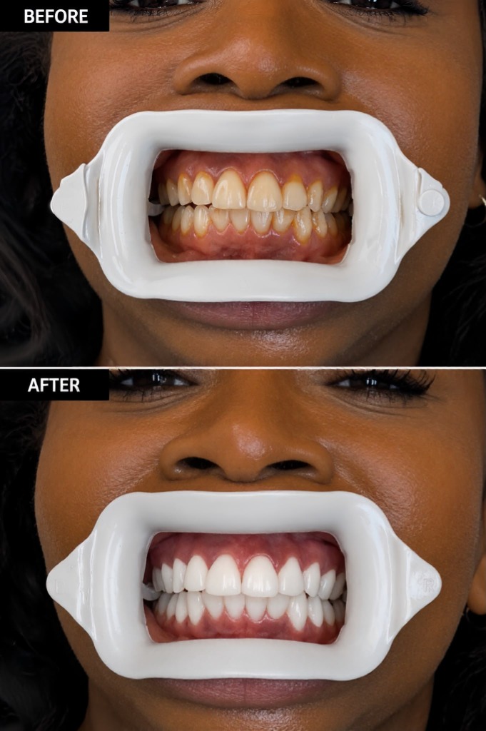 Teeth Whitening In-Clinic Treatment 3